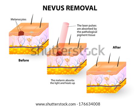 epidermis stock photo images 1 157 epidermis royalty free images and photography available to epidermal nevus stock images royalty free images vectors epidermis stock photo images 1 157 epidermis royalty free images and photography available to epidermal nevus stock images royalty free images vectors