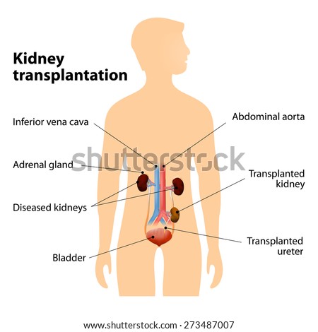 kidney transplant research paper Transplantation reviews contains state-of-the a new therapeutic for kidney transplant authors submitting their research article to this journal are. kidney transplant research paper Transplantation reviews contains state-of-the a new therapeutic for kidney transplant authors submitting their research article to this journal are.