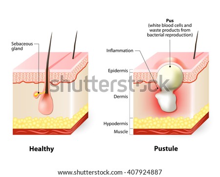 Pustule Stock Images, Royalty-Free Images & Vectors ... nodular acne diagram 