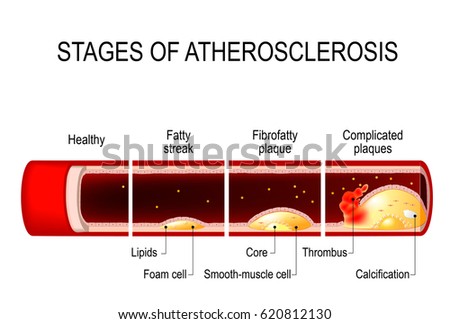 Atherosclerosis Stock Images, Royalty-Free Images & Vectors | Shutterstock