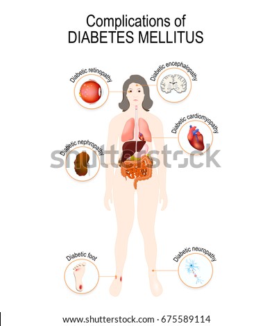 Diabetic Neuropathy Types Symptoms Prevention Treatment