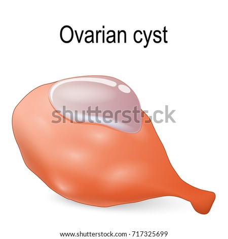 Ovarian Cyst Fluidfilled Sac Ovary Stock Illustration 717325699 ...