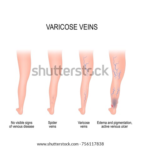 Edema Stock Images, Royalty-Free Images & Vectors ...
