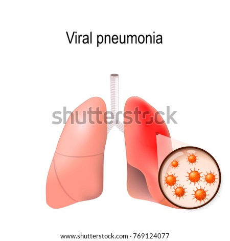 Pulmonary Pathology Stock Images, Royalty-Free Images & Vectors