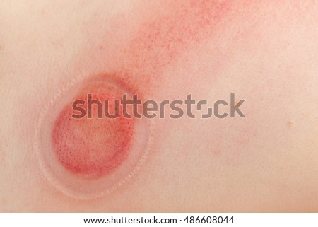 scar on human skin stock photo 209040517 scar on human skin stock photo 209040517 scar on human skin stock photo 209040517 scar on human skin stock photo 209040517