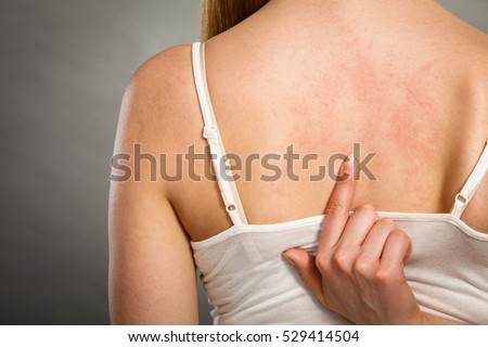 Rash Stock Images, Royalty-Free Images & Vectors ...