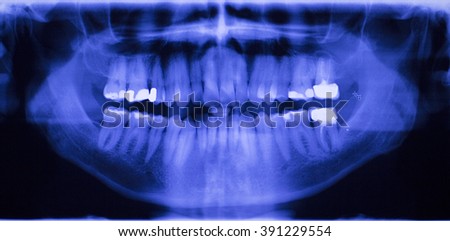 Gingivitis Stock Images, Royalty-Free Images & Vectors | Shutterstock