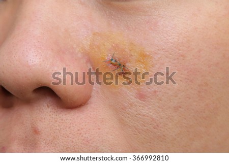 burn scar stock photo 57476164 burn scar that partly healed stock photo 16554190 burn scar stock photo 57476164 burn scar that partly healed stock photo 16554190