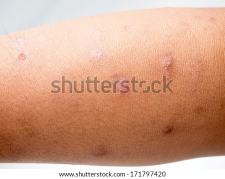 Ring Worm Infection Dermatophytosis On Skin Stock Photo 484652500 ...