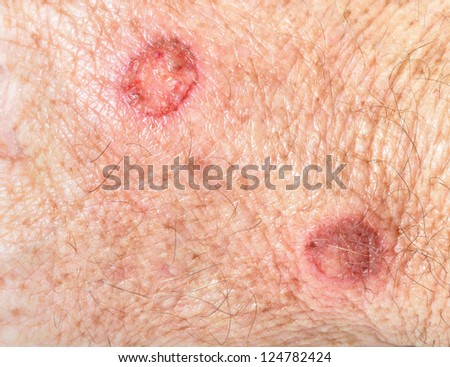 Liquid nitrogen on precancerous facial skin
