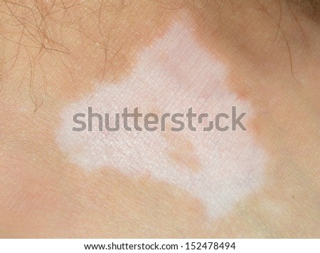 scar on human skin stock photo 209491861 scar on human skin stock photo 209040517 scar on human skin stock photo 209491861 scar on human skin stock photo 209040517