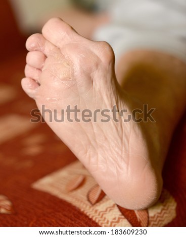 Hyperkeratosis Stock Images, Royalty-Free Images & Vectors | Shutterstock