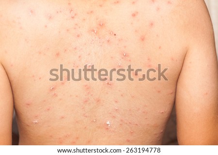 chicken pox in a sexy body heidi klum pussy nude