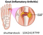 Diagram Showing Gout In Human...
