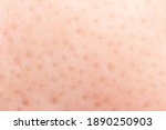 Small photo of Macro shot of blackheads on facial skin, clogged pores