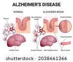 brain diseases  alzheimer's... | Shutterstock .eps vector #2038661366