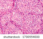 Small photo of Carcinoid tumour is a rare, slow-growing tumour arising from the enterochromaffin cells. It is the most common malignant tumour of the appendix. It appear as nests of monotonous polygonal cells.