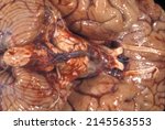 Small photo of Gross anatomy of the ventral surface of a human brain showing cerebellum, medulla oblongata, pons (with subarachnoid diffuse hemorrages), optic chiasm and nerves tract and olfactory tract and bulb