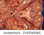 Small photo of Gross anatomy of the base of a human brain. The cerebellum, medulla oblongata, pons, optic chiasm and nerves tract and olfactory tract can be seen in the midline.