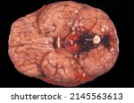 Small photo of Gross anatomy of the ventral surface of a human brain showing an acute basal subarachnoid hemorrhage affecting the cerebellum base, medulla and pons.