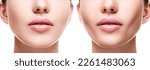 Small photo of Female face comparison after successful buccal fat extraction plastic surgery