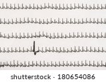 Small photo of Extrasystole On Electrocardiogram Record Paper