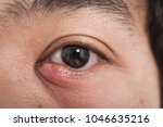 Small photo of Close up of eye handsome man have abscess stye under the eyes, hoodlum infection virus or disease during open eye, Health concept
