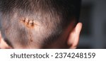 Small photo of The lacerated sutured wound of kid back head which suture by nylon suture about 3 stitches at the emergency room of the hospital, Medical care of the surgery lesion on the head, children of Accident