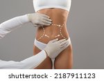 Body Contouring Concept. Unrecognizable Doctor Wearing Gloves Touching Female Body With Marked Lines In Abdomen Zone, Woman Patient Preparing For Liposuction Plastic Surgery, Cropped Shot