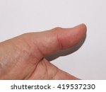 Small photo of left thumb finger joint get sudden, intense pain in a night without warning looks like gout or rheumatoid symptom, Inflammation, redness, swollen, tender, warm and limited motion movement