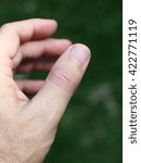 Small photo of left thumb finger joint get sudden, intense pain in a night without warning like gout or rheumatoid symptom, Inflammation, redness, swollen, tender, warm and limited motion movement, green background