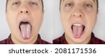 Small photo of Before and after. White curd on the tongue. A physician or gastroenterologist examines a man tongue. Patient has poor oral hygiene or a symptom of illness. Symptoms of a latent disease.