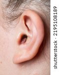 Small photo of Close up of abscess Inflammation on the ear, area of suppuration. Ear furuncle. Purulent carbuncle. Treatment of abscess
