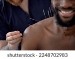 Small photo of acupuncture therapy on back spine shoulders for black male client. cropped man undergoing acupuncture treatment with a line of fine needles inserted into body skin in clinic hospital, close-up