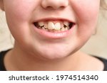 Crooked teeth in a child girl, close up