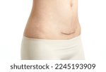 Small photo of Closeup of woman belly with a scar from a cesarean section on white background