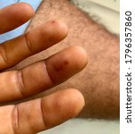 Small photo of Multiple petechiae hemorrhage at fingers in case infective endocarditis.