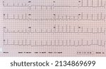 Small photo of The electrocardiogram that shows atrial fibrillation in a man who present at emergency room with problem of palpitation.