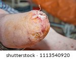 Small photo of Amputation. Stump of the thigh. Suppuration of wounds. Purulent surgery. Diabetes. Close-up of an elderly man's amputated leg in the hospital.