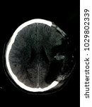 Small photo of Axial plain or sagittal cut of CT scan brain showing partial or partly skull bone absence after surgery to remove comminuted fracture of skull in young male patient with history of severe head injury