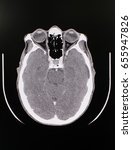 Small photo of Frontal or axial plain of CT scan presenting normal study of brain parenchyma, ethmoidal sinus air cell , orbital globe and other intracranial structure