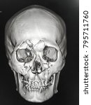 Small photo of Zooming closeup reconstruction CT head & neck region showing comminuted fracture at frontal sinus , zygomatic arch , maxillary and orbital bone in a young Asian female patient with traffic accident