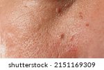 Small photo of Wart skin removal. Macro shot of warts near eye on face. Papilloma on skin around eye nose and neck. Birthmark Papilla or mole on skin. small hard. benign growth on the skin caused by virus. Skincare