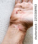 Small photo of electric shock entry and exit wounds and burns in 50s adult caucasian man hand wrist healing and skin peeling after medical treatment.