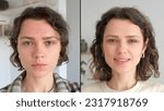 Small photo of Two close up faces of young beautiful woman show real result before and after acne treatment. Split screen. Home background. Concept of acne therapy, scars, inflammation on face and problem skin. UGC