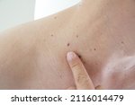 Small photo of Mole or wart on the men skin