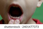 Small photo of Close up, boy opens his mouth and shows his milky teeth. One missing tooth replaced with permanent toot. . High quality photo