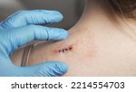Small photo of Examination of the sutured wound close-up. The doctor in medical gloves touches the sewn scar. Open wound, trauma. 4K UHD