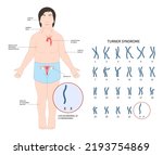 Turner and fragile syndrome of the X chromosomal abnormality test genetic with gonadal dysgenesis disorder in female