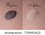 Small photo of Mole removal inborn